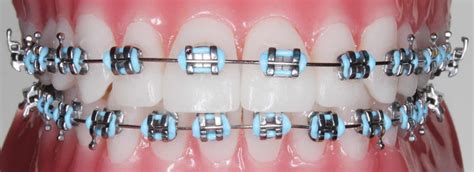 sticker metal bracket braces|Metal Braces A Complete Guide to Traditional Orthodontic .